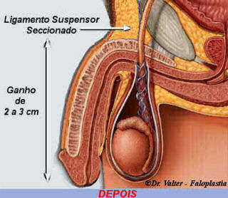 Aumento do P&ecirc;nis por Cirurgia