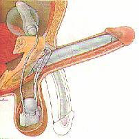 Implante 2